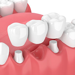 Dental Bridges - Vails Gate, NY Dentist | Advanced Dental
