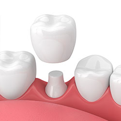 In-Home Crowns | Frank Andriani, DDS
