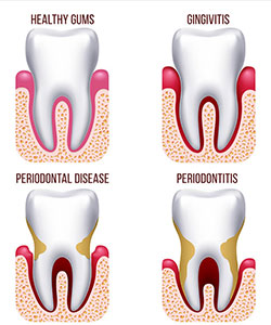 periodontitis in Gilbert, AZ | Creative Smiles