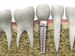 implants in Woodridge, IL | Hobson Dental Associates