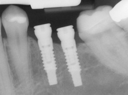 X-ray of an implant in position | Brooklyn, NY Dentist